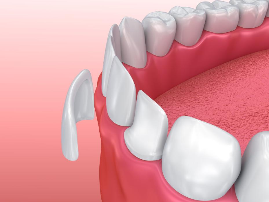 dental veneers in troy ny