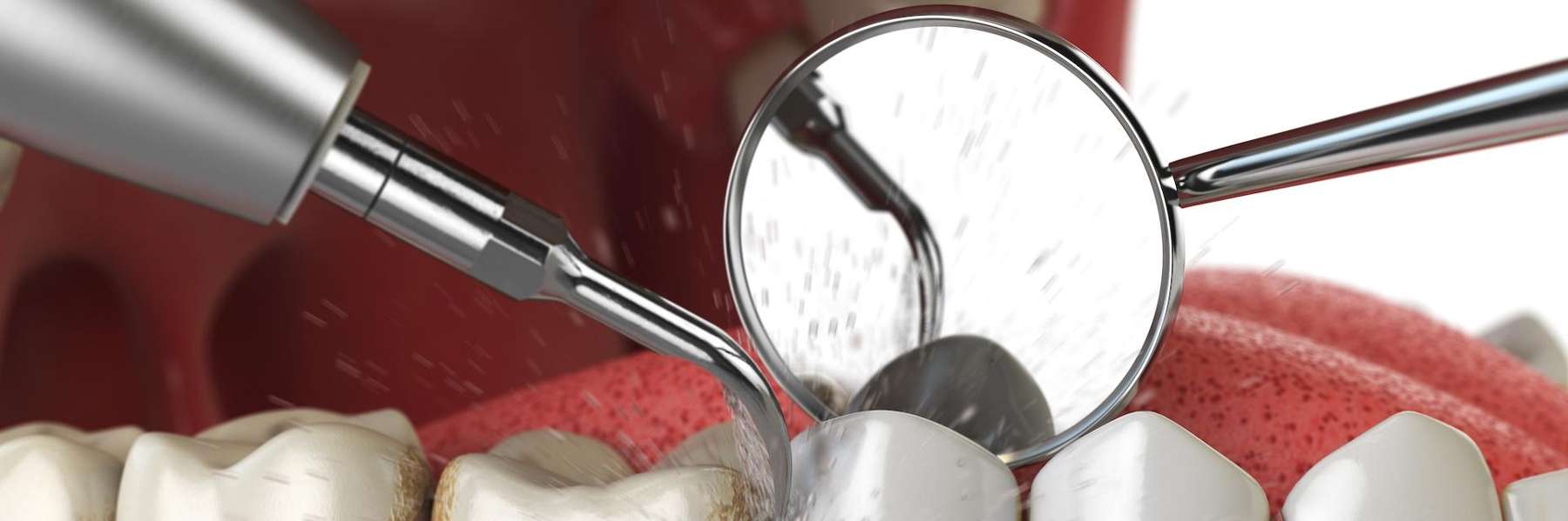 dental cleaning of accumulated tartar in Troy NY