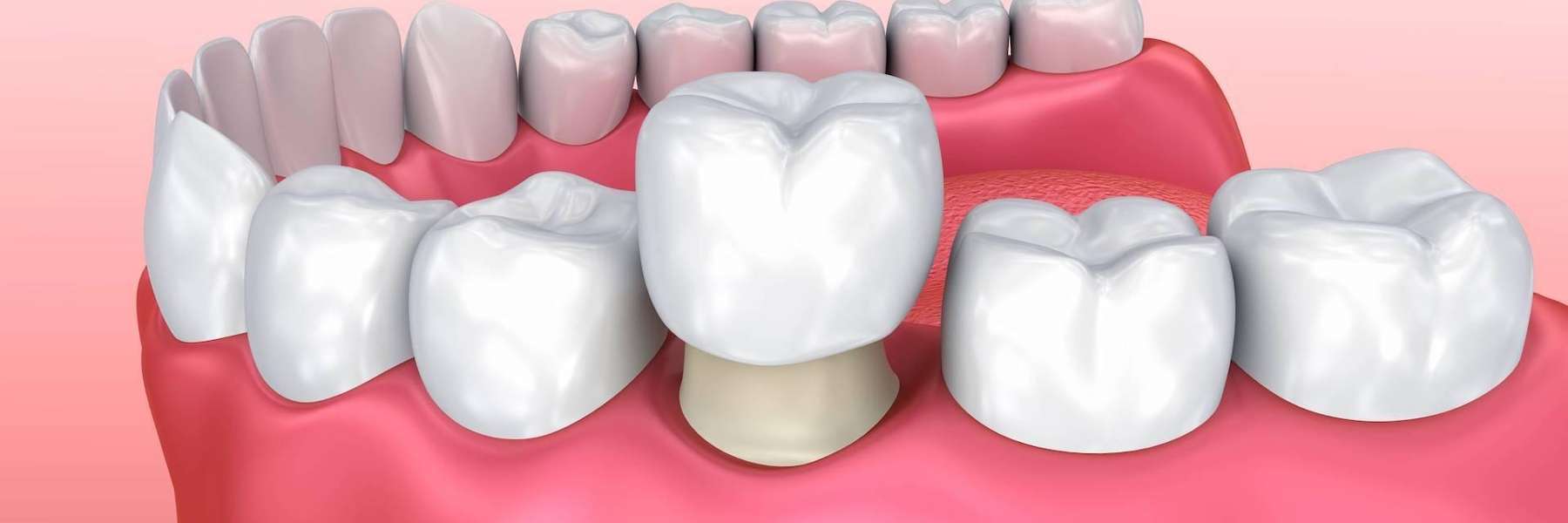 tooth crowns at the dental office near me in Troy