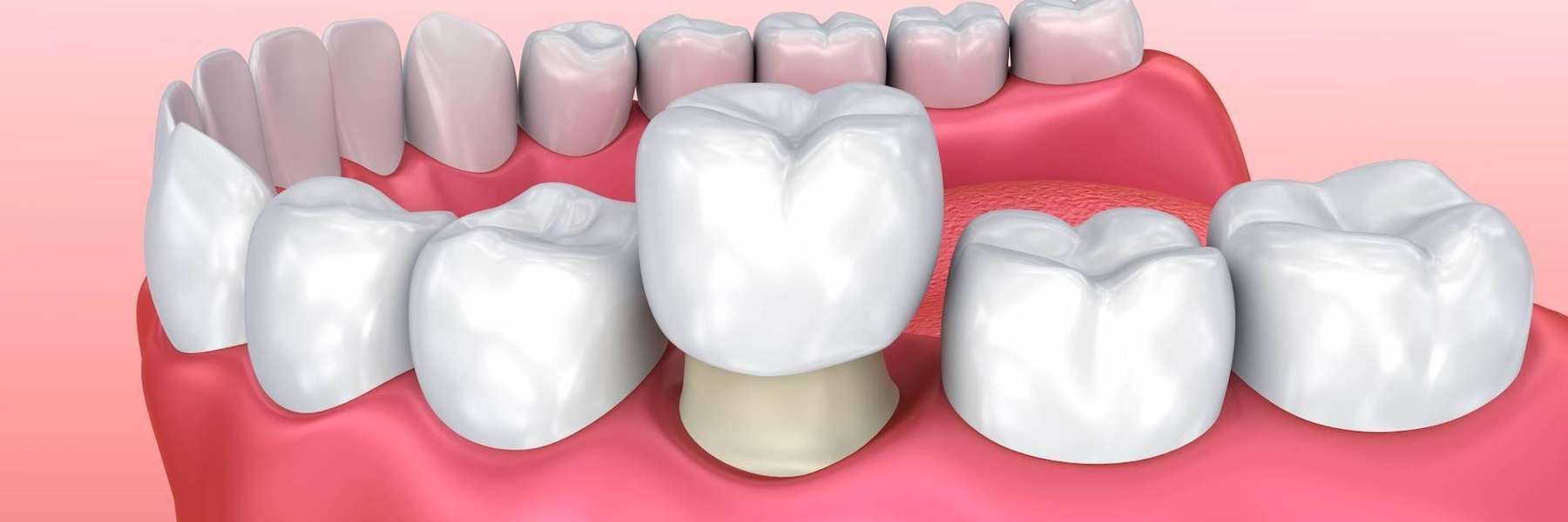 dental crowns at Evergreen Dental Care