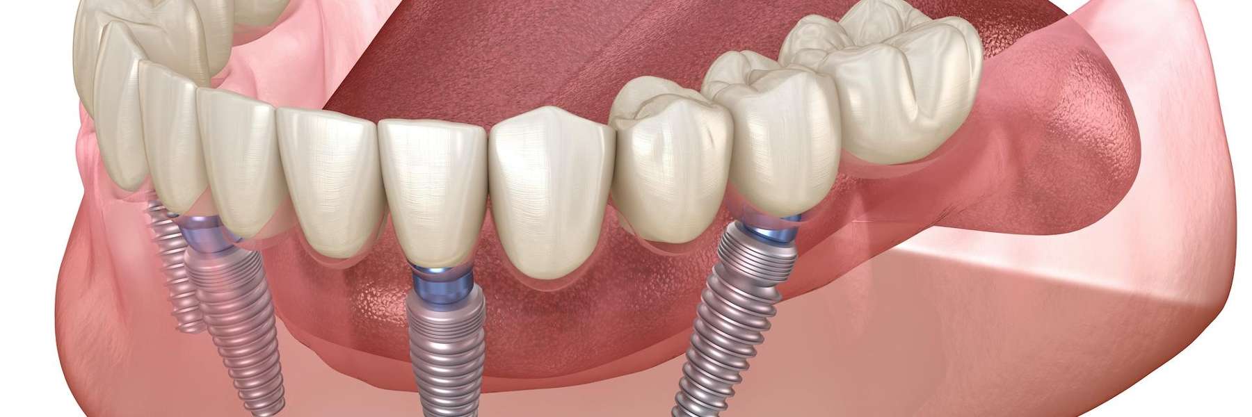 Possible Side Effects of Partial Dentals: What You Need to Know