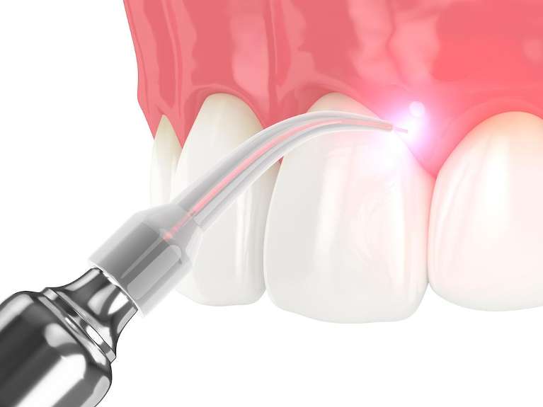 laser dentistry in troy ny